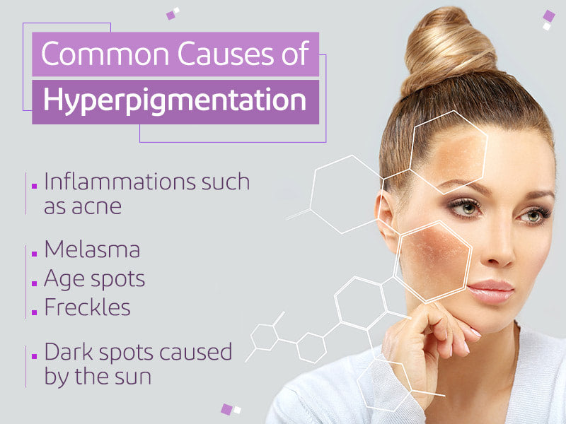 MELASMA AND HYPERPIGMENTATION